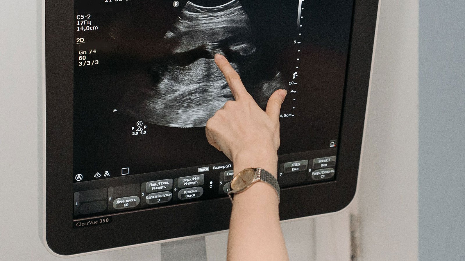 Pólipos uterinos: cómo se diagnostican y cómo se tratan
